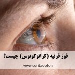 قوز قرنیه (کراتوکونوس) چیست؟