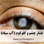 فشار چشم و گلوکوم؛ وقتی تنگی کانال تخلیه، متهم اصلی است